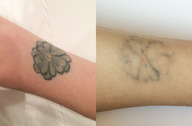Laser tattoo removal: What it's really like to have a tattoo removed ...
